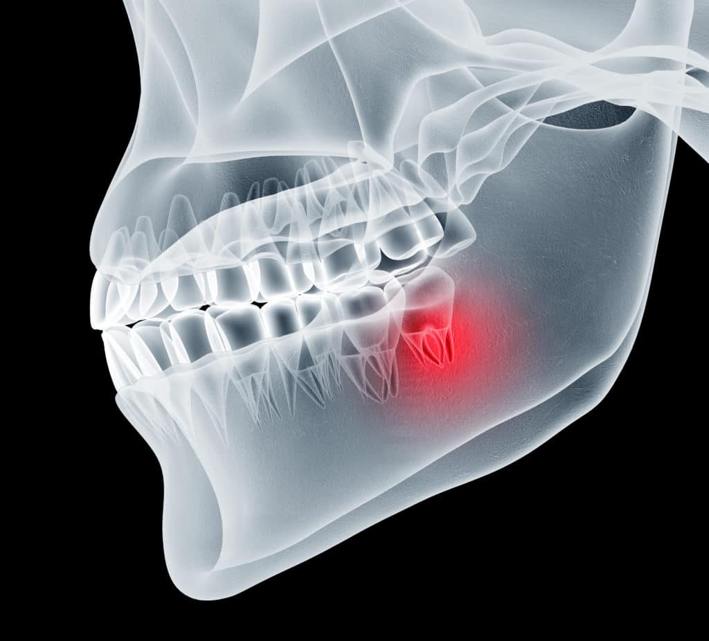 When Is It Necessary To Remove Wisdom Teeth? | Hendersonville Family Dental